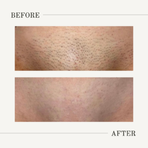 brazilian laser hair removal