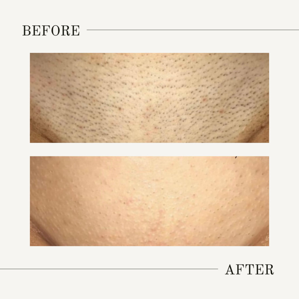 Bikini, Brazilian, and buttocks laser hair removal at NOVALUNE in Denver provides smooth, long-lasting results. Check out our before-and-after examples!