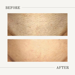 Bikini, Brazilian, and buttocks laser hair removal at NOVALUNE in Denver provides smooth, long-lasting results. Check out our before-and-after examples!