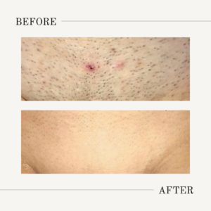 full brazilian laser hair removal before and after photos