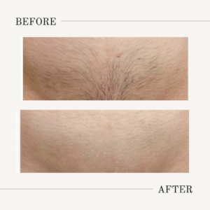 brazilian laser hair removal cost