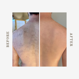 Back Laser Hair Removal Services in Denver | NOVALUNE