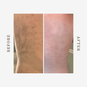 Struggling with a hairy back? Try full back laser hair removal in Denver for a smooth, hassle-free solution with impressive before and after results.