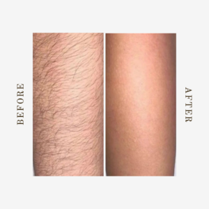 Arm Laser Hair Removal in Denver | Before & After | NOVALUNE