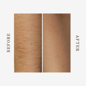 Discover the transformation with arm laser hair removal in Denver: enjoy silky smooth skin with visible results from before and after treatments.