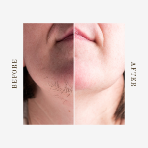 Denver lip and chin laser hair removal