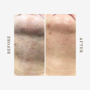 Denver chin laser hair removal before and after