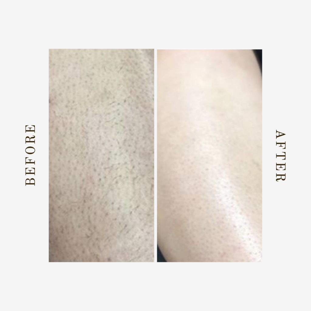 Experience smooth, hair-free legs year-round with our full leg laser hair removal in Denver. Choose between full or lower legs for lasting results.