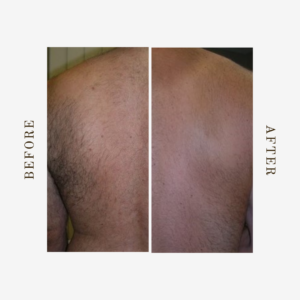 full back laser hair removal Denver