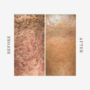 Denver Full Neck, Back, Front, and Beard Laser Hair Removal for Women & Men