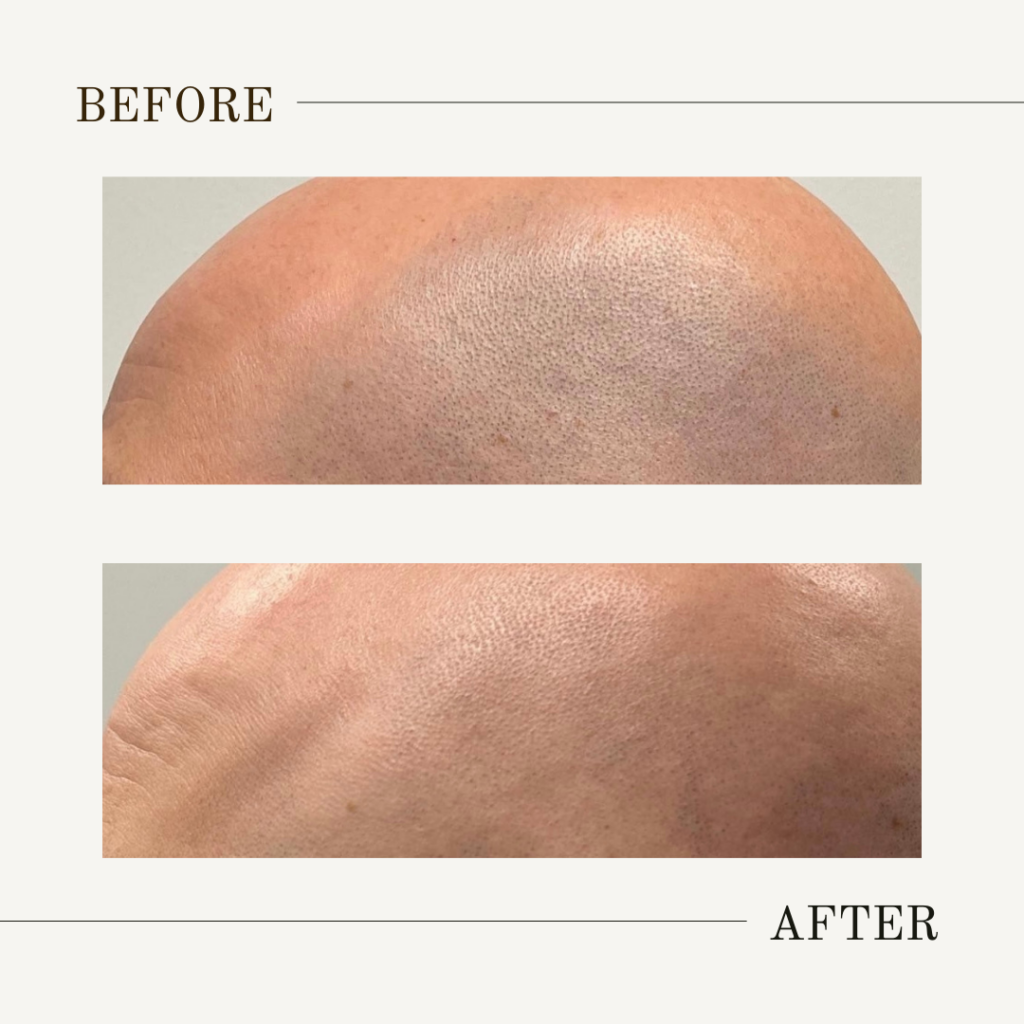 Denver Laser Hair Removal For Head | Scalp Laser Hair Removal Near Me