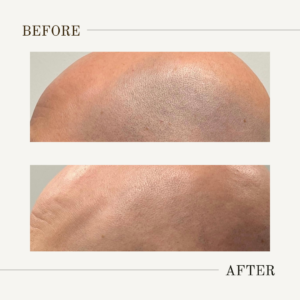 Denver Laser Hair Removal For Head | Scalp Laser Hair Removal Near Me