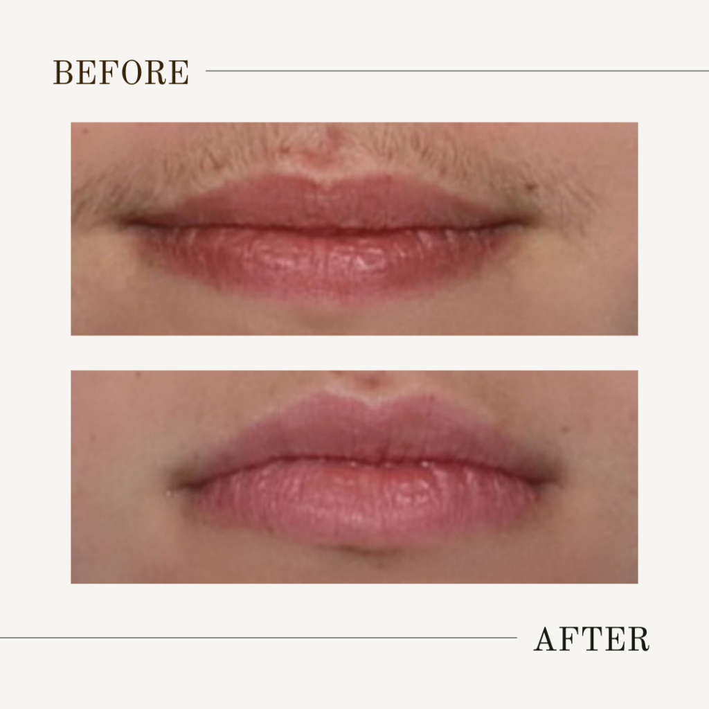 Denver upper lip laser hair removal services