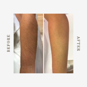 permanent arm hair removal