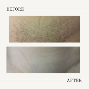 bikini laser hair removal treatment