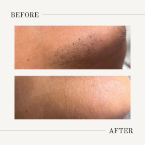 top lip and chin laser hair removal cost