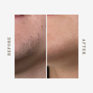 lip and chin laser hair removal