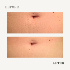 laser hair removal for chest and stomach