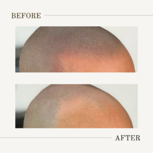 scalp laser hair removal cost