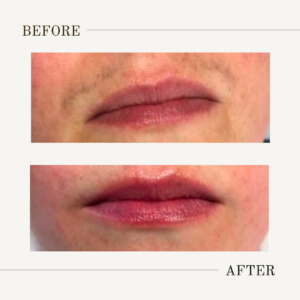 lip and chin laser hair removal cost