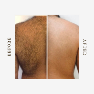 denver permanent back hair removal