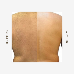 permanent back hair removal treatment