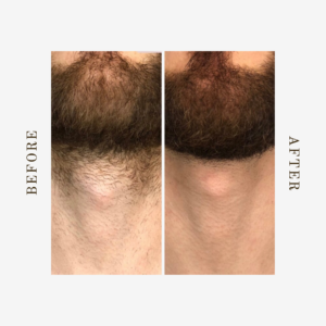 denver laser treatment for facial hair